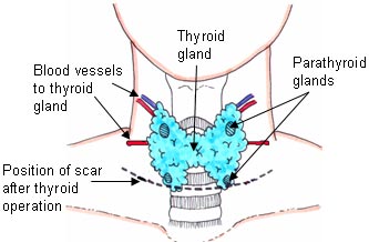 Thyroidectomy Goitre Treatment 